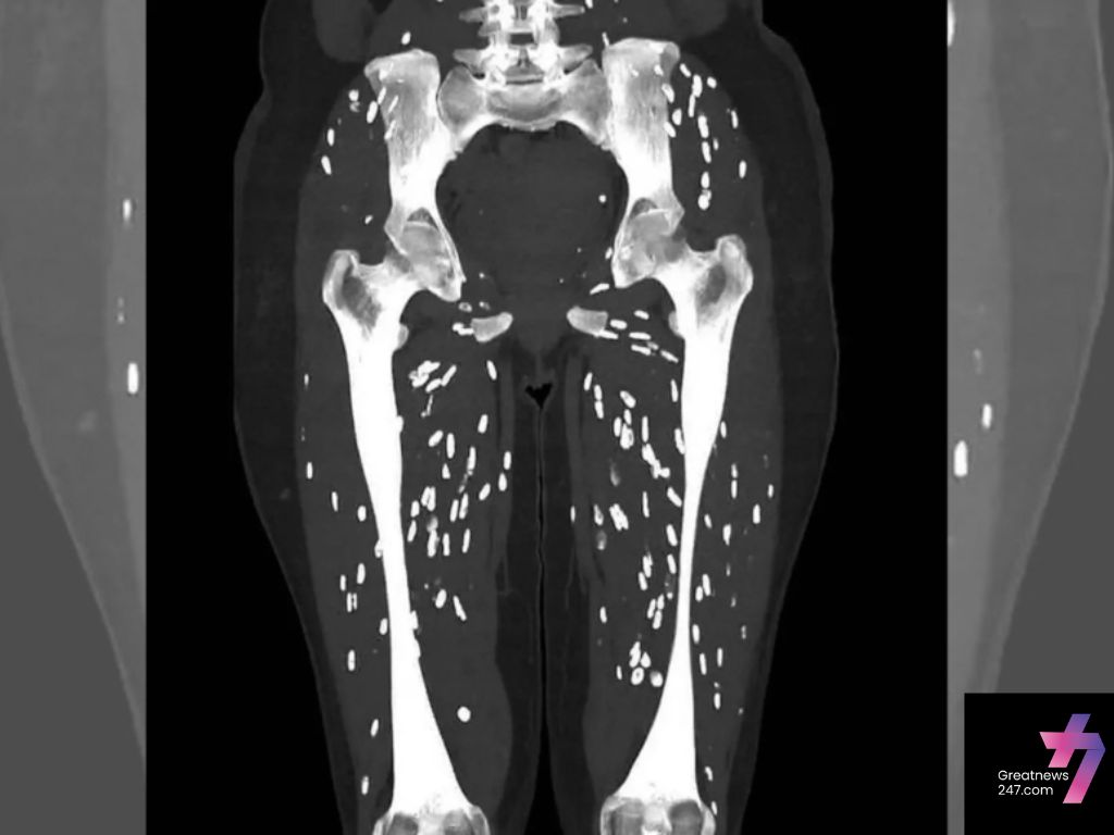 ‘Wildest’ CT Scan Shows Tapeworm Cysts in Patient’s Legs: Here’s Why